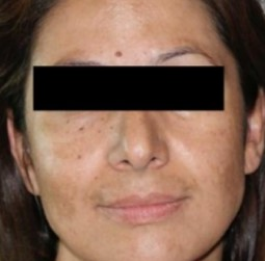 Before/After Image